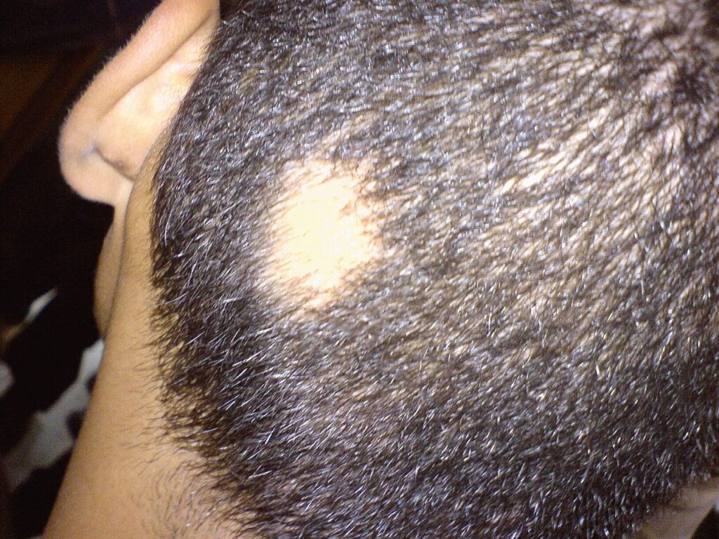 A hairless patchy spot of Alopecia Areata. 