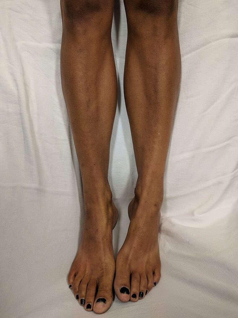 Addison's disease - Legs of a Caucasian woman with Addison's disease (primary adrenal insufficiency)