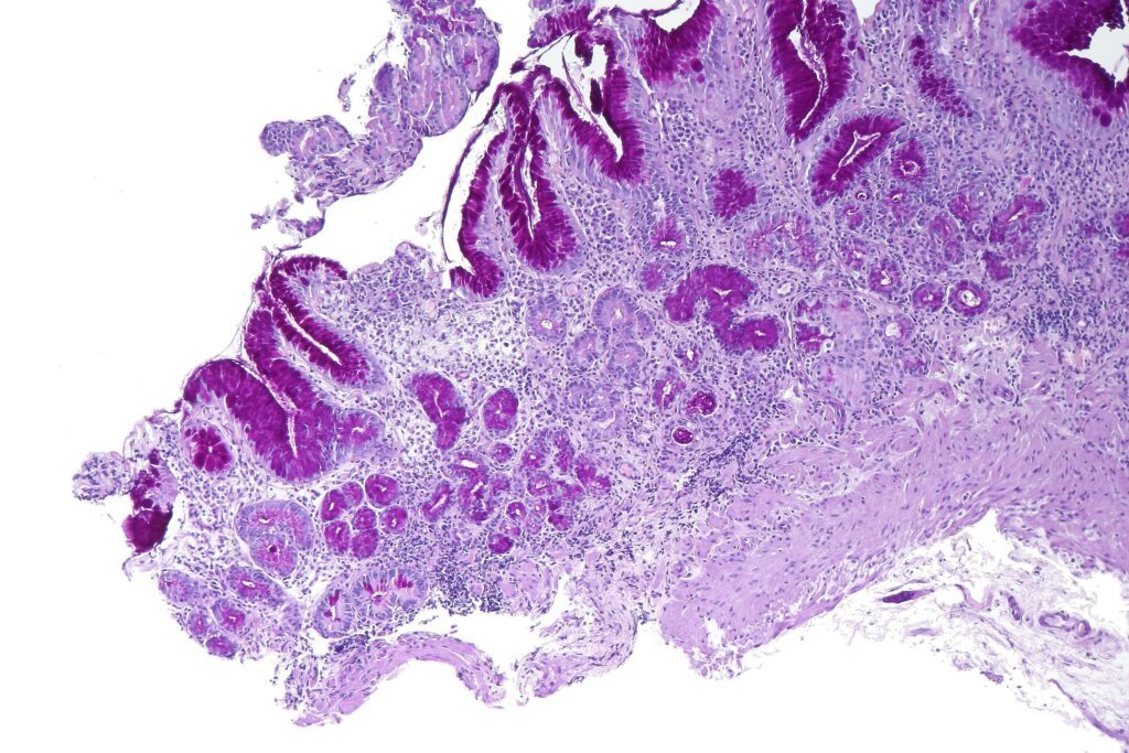 Atrophic gastritis showing patchy atrophy of oxyntic mucosa in Pernicious Anemia (PA)