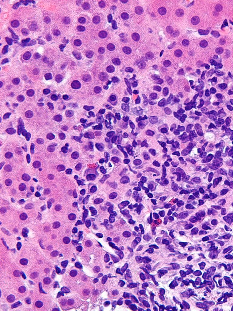 Micrograph showing a lymphoplasmacytic interface hepatitis—the characteristic histomorphologic finding of autoimmune hepatitis (AIH). Liver biopsy. H&E stain.