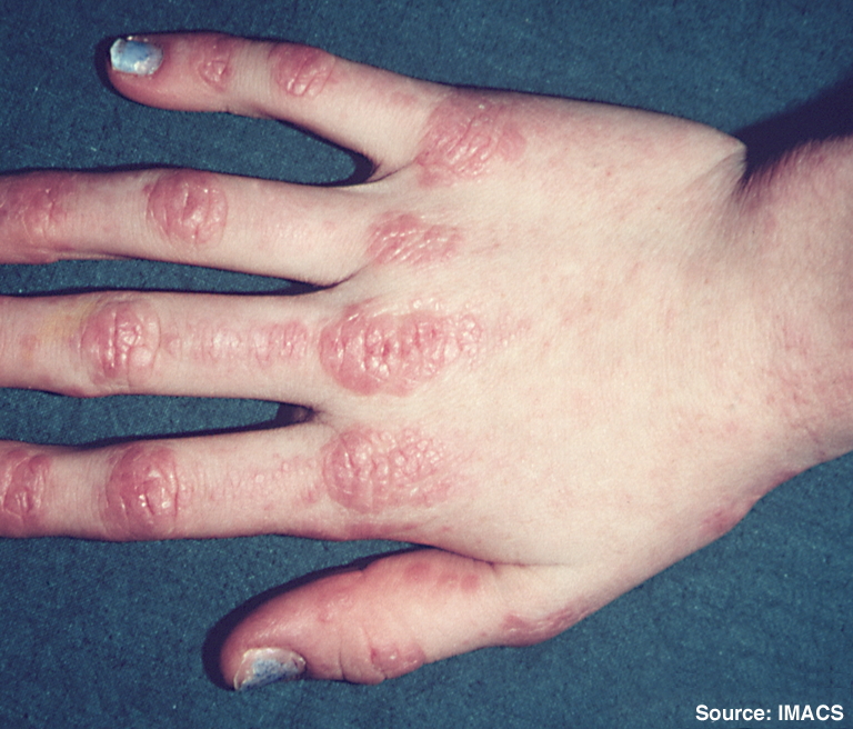 Dermatomyositis