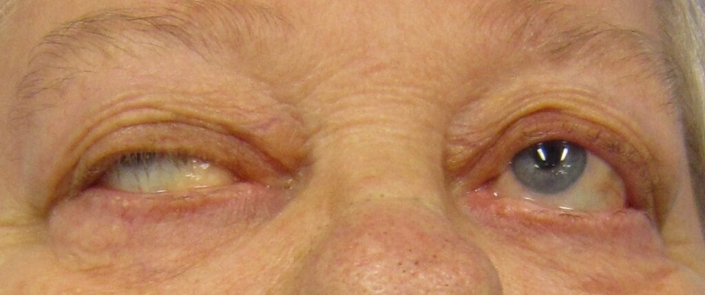 Strabismus in a person with myasthenia gravis trying to open their eyes.