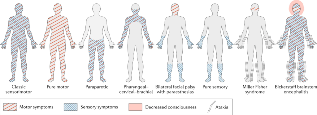 Guillain-Barré Syndrome