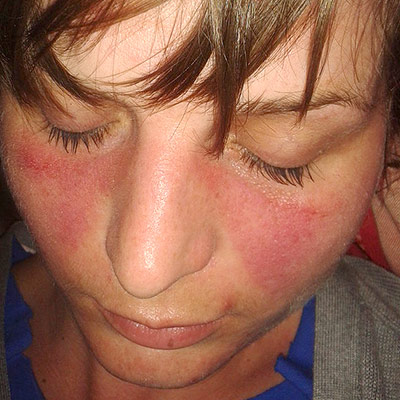 Young woman with the distinctive butterfly rash that many individuals with lupus experience