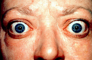 Photograph showing a classic finding of Graves' Disease, proptosis and lid retraction.