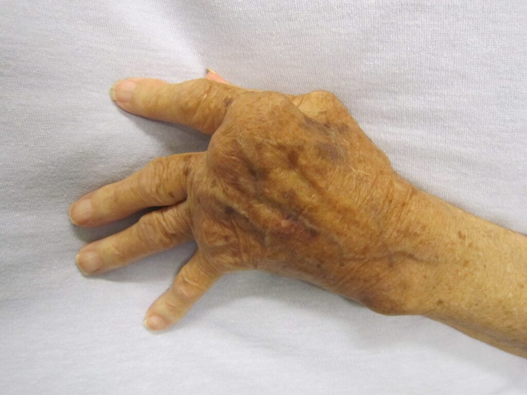 A hand severely affected by rheumatoid arthritis. 
This degree of swelling and deformation does not typically occur with current treatment.