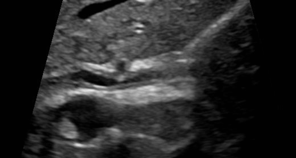 Primary Sclerosing Cholangitis (PSC)