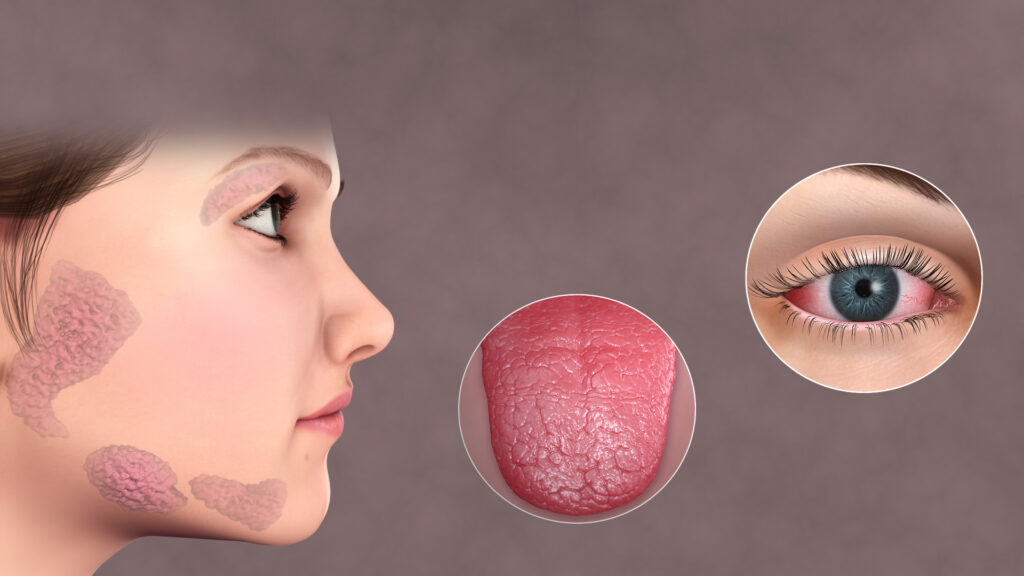 Characteristic dryness in Sjögren’s Syndrome appears at a number of locations, such as the tongue, face, and eyes. Marked at left are the salivary glands (which may be swollen), not a facial rash.