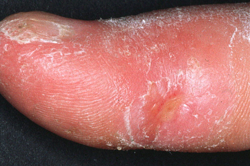 Clinical appearance of acrosclerotic piece-meal necrosis of the thumb in a patient with systemic sclerosis (scleroderma).