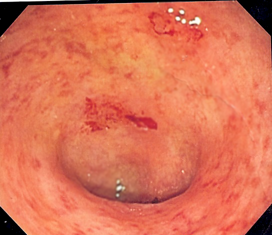 Endoscopic image of ulcerative colitis showing loss of vascular pattern of the sigmoid colon, granularity and some friability of the mucosa