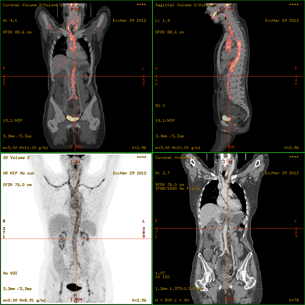 Autoimmune Vasculitis